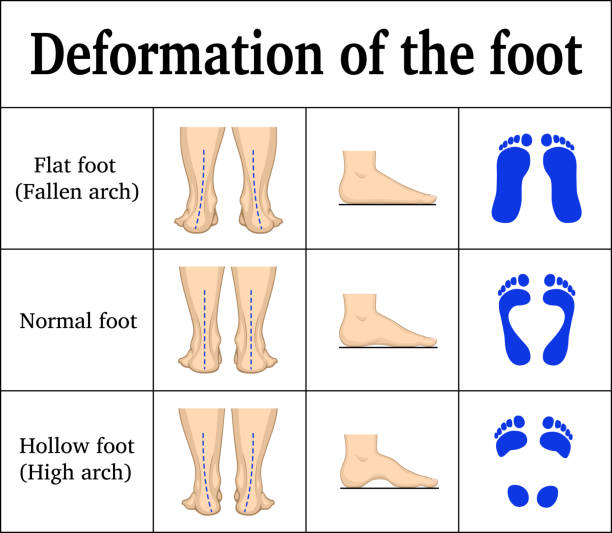 How to choosing running shoes Based on Your Running Style